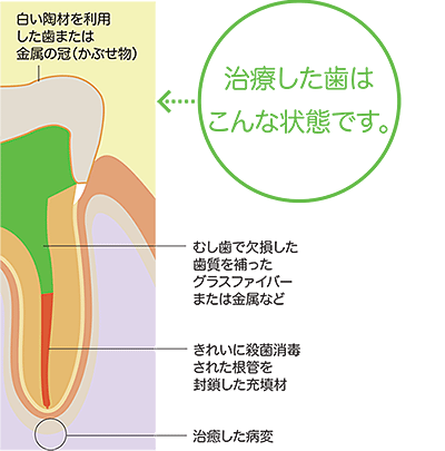 歯管治療画像2