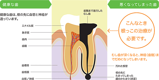 歯管治療画像1