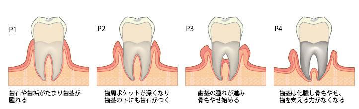 門真の歯医者かわさき歯科です 門真の予防歯科 歯周病 虫歯治療 小児歯科は当歯科医院へどうぞ